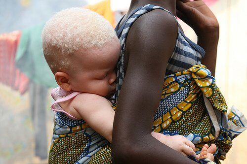 Черная мать с ребенком-альбиносом