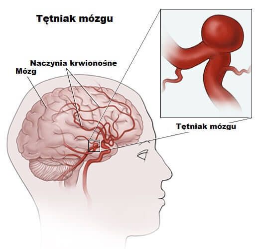 Развивающаяся аневризма мозга