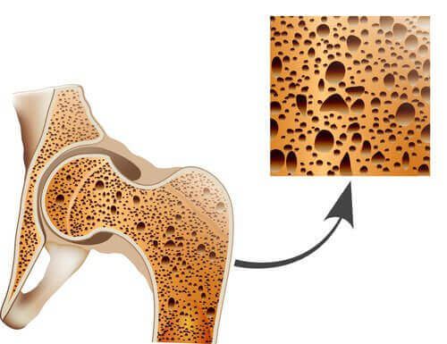 Костная структура и остеопороз