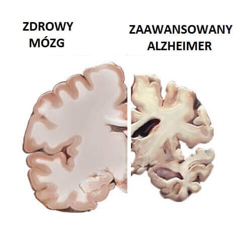 мозг болезнь Альцгеймера