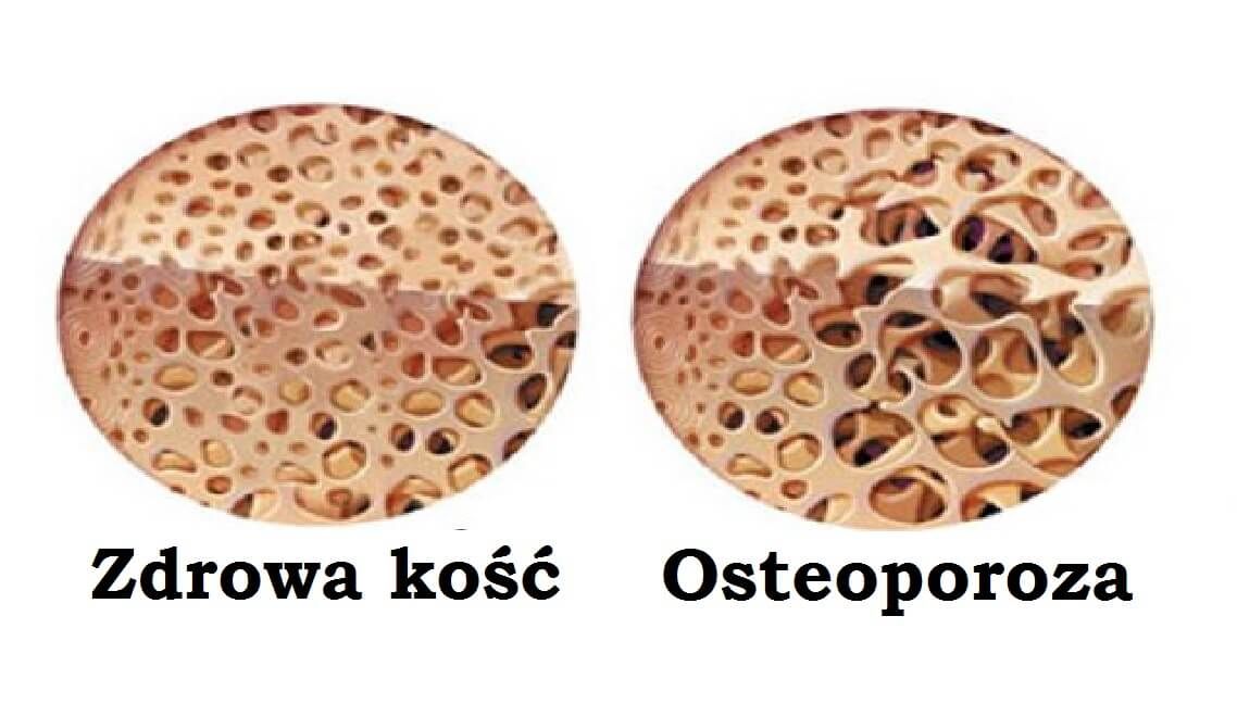 Кости и остеопороз