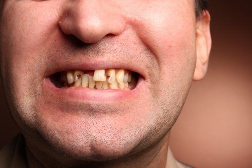 Сломанные зубы