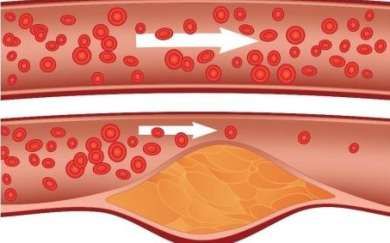 Холестерин в кровеносных сосудах