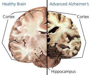Изменения в мозге человека, пострадавшего от болезни Альцгеймера