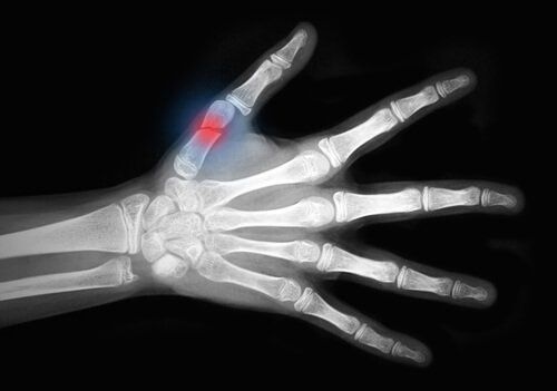 Рентген - сломанный палец