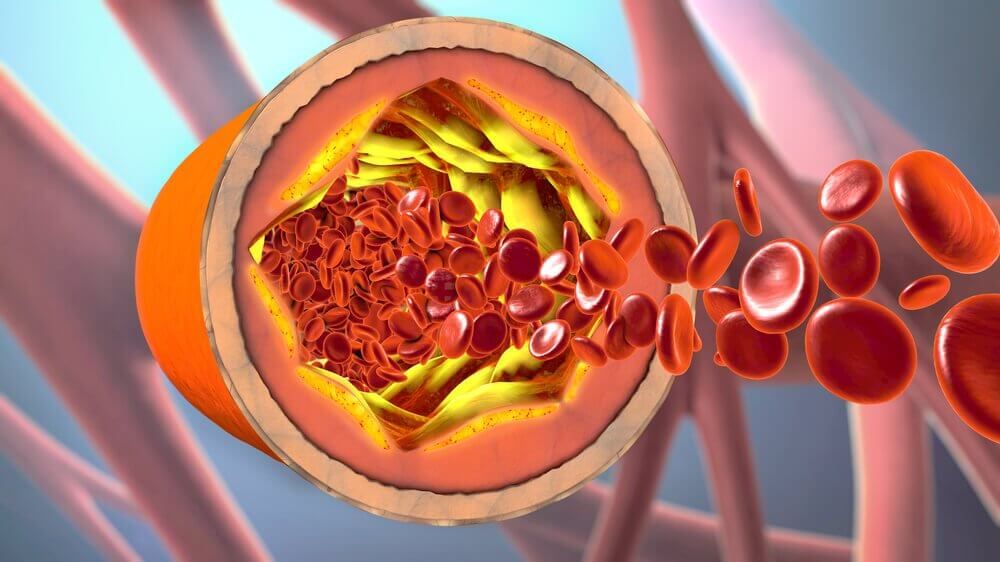 Отложения холестерина внутри кровеносных сосудов