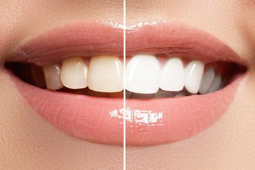 Зубы-отбеливание зубов