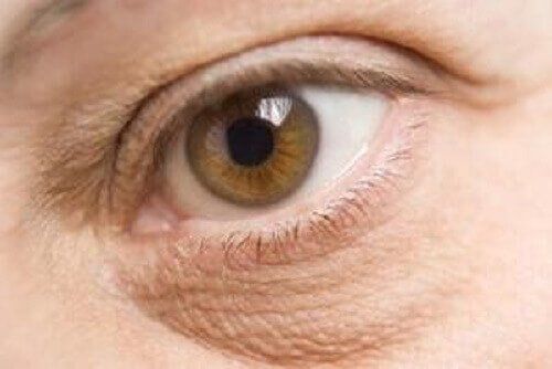 Сухость глаза может быть следствием дефицита витаминов и минералов