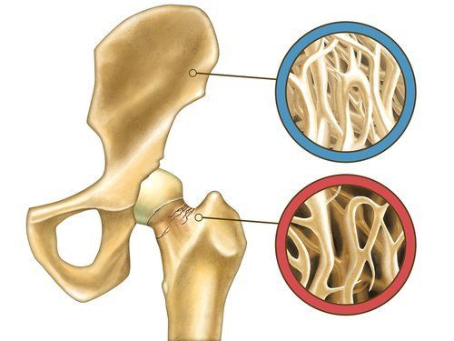 Кость с остеопорозом