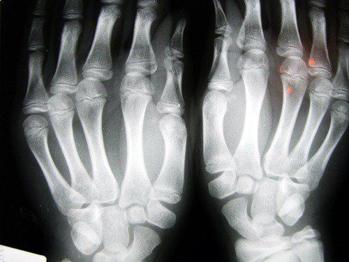 Рентгеновское изображение, показывающее дегенерацию пальцев