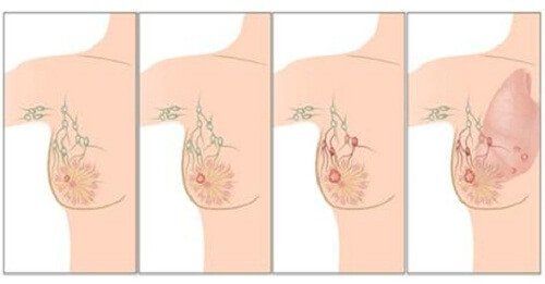 Рак молочной железы - стадии