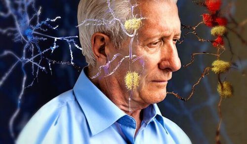 Симптомы Альцгеймера