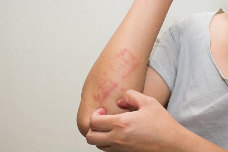 негерметичный кишечный синдром может вызвать проблемы с кожей