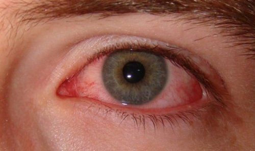 Кровожадный глаз Синдром сухого глаза