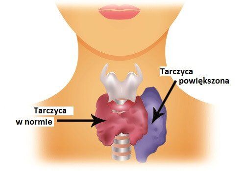 Гиперактивность thyroid-