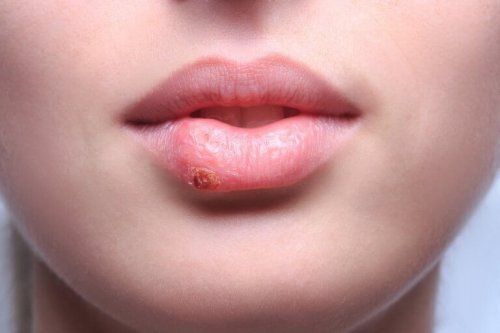 Сыпь в области рта и носа
